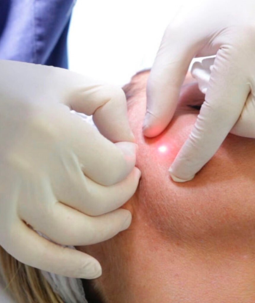 Endolaser, also known as Endolift.